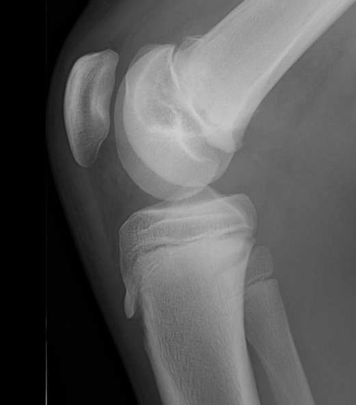 Distal Femoral Fracture SH2 Lateral